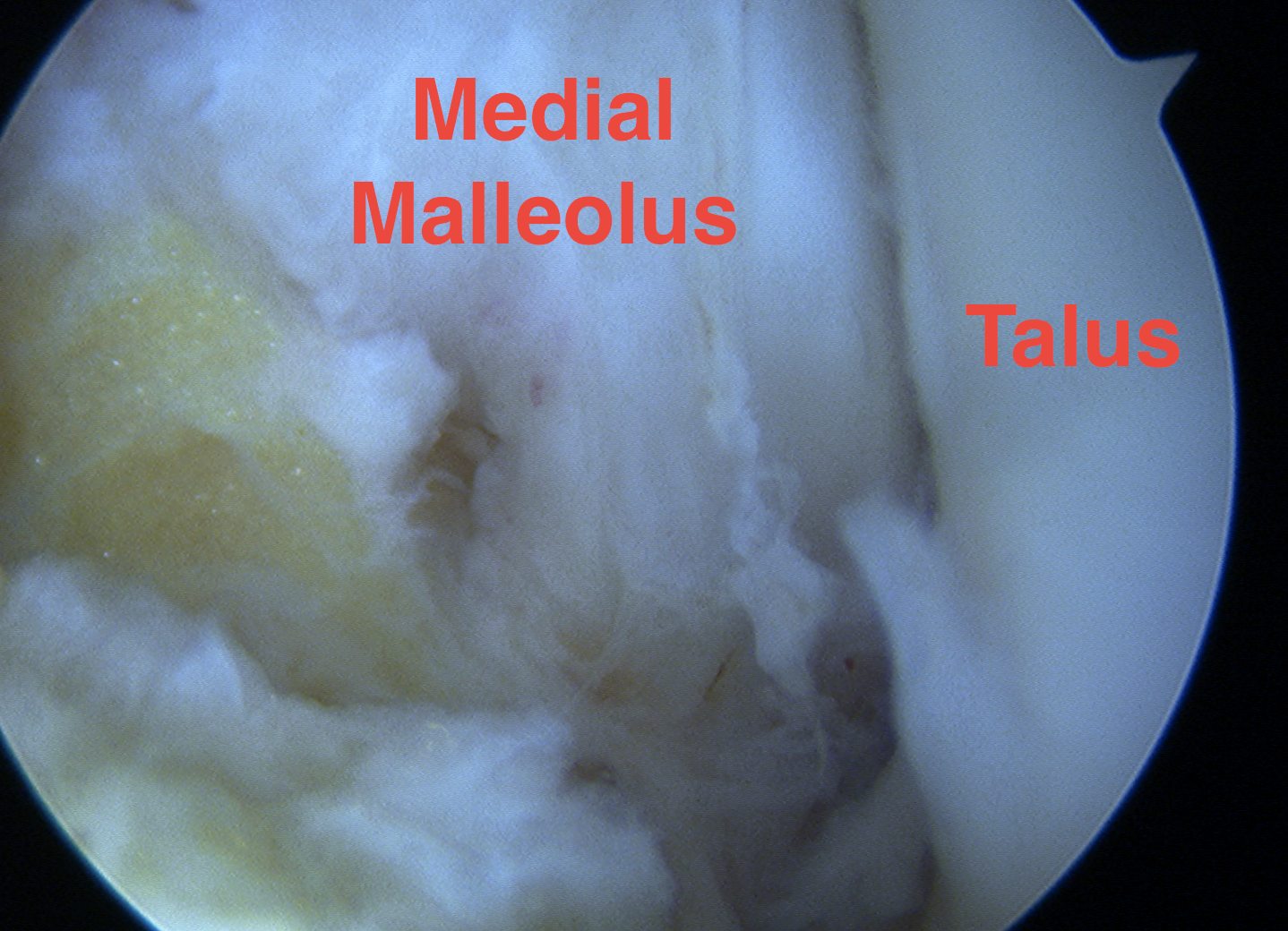 Ankle Scope Medial Gutter